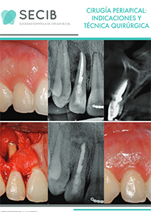 cirugia periapical secib