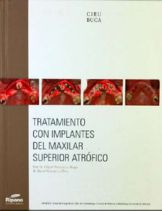 tratamiento implantes maxilar superior