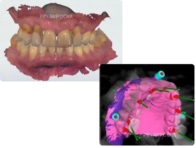 Cirugia guiada carga inmediata arcada completa