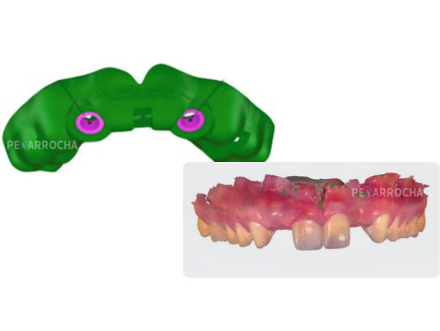 Grupo objetivo cirugia guiaga implante