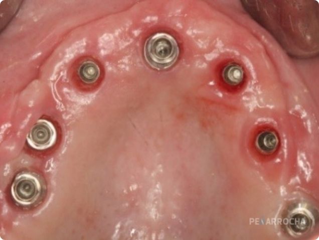 Implantes nasopalatinos ejemplo