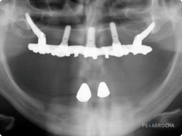 Implantes nasopalatinos indicacion