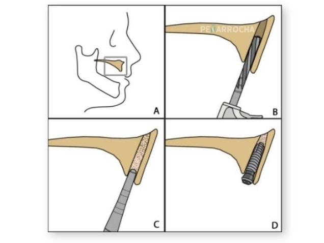 Implantes nasopalatinos proceso