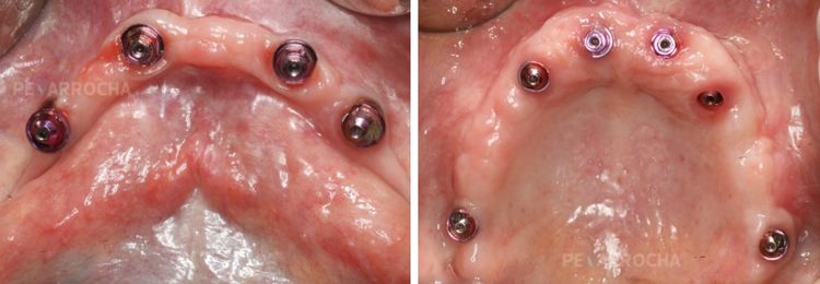 Implantes pterigoideos 2