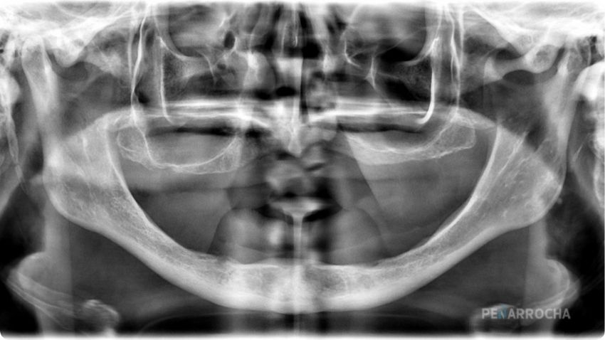atrofiasevera tratamiento implantes cigomaticos