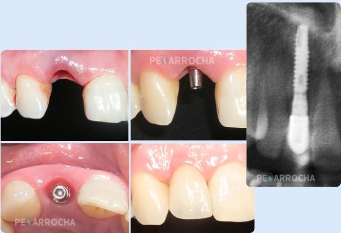 indicaciones tratamiento implantes de carga inmediata en valencia