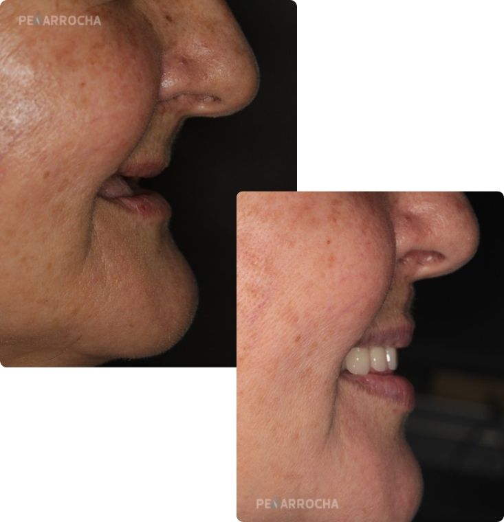 caso antes despues implantes cigomaticos