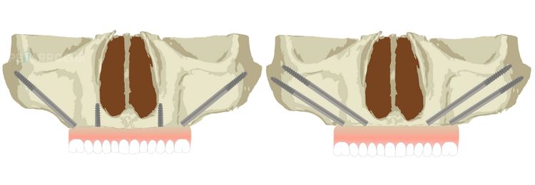 colocacion implantes cigomaticos