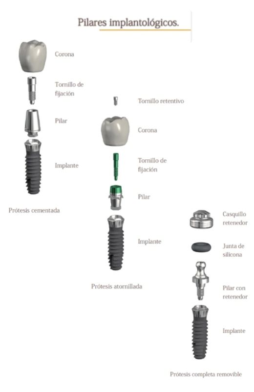 como se coloca una protesis sobre implantes
