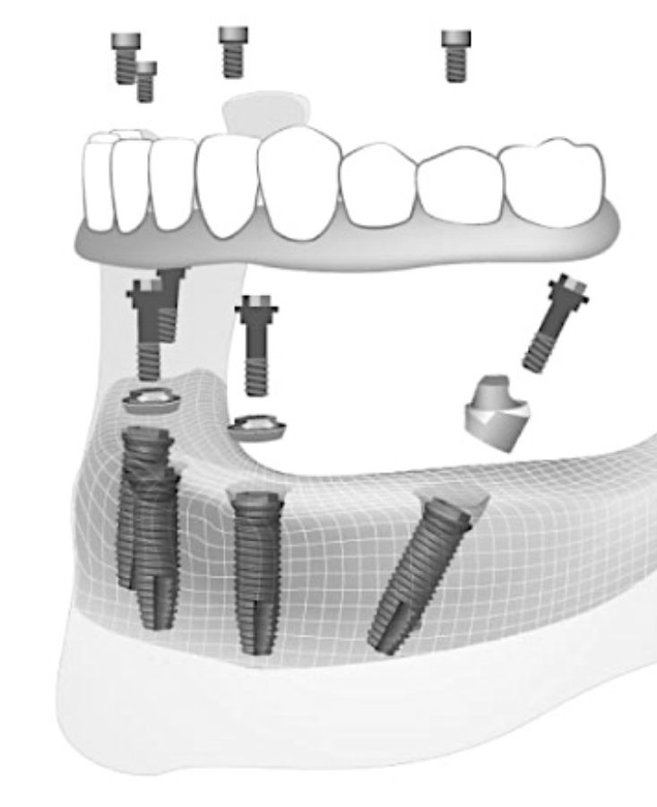como se realiza el tratamiento implantes all on four