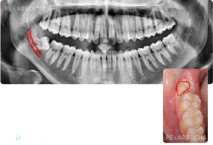 coronectomia tratamiento dientes incluidos extraccion de muelas del juicio en valencia dres penarrocha