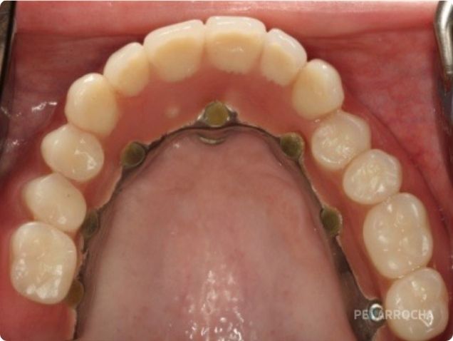 cuidados implantes nasopalatinos
