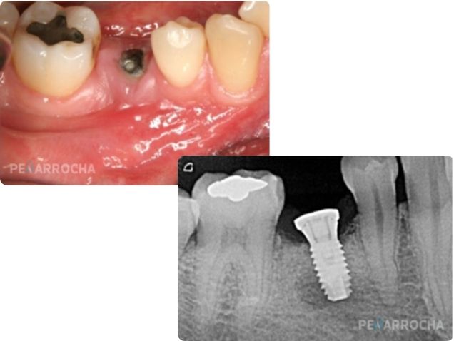 dolor e inflamacion por infeccion en implante