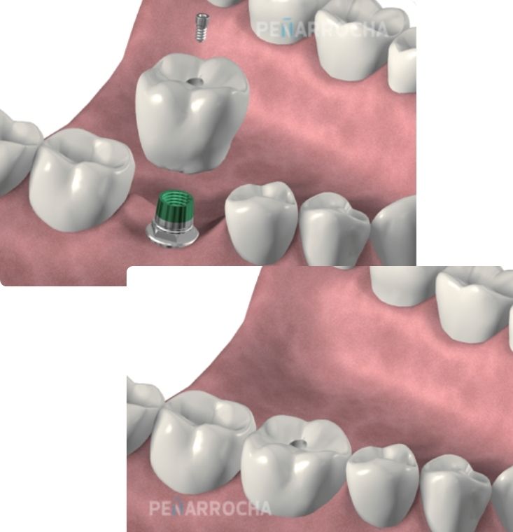 ejemplo protesis sobre implantes atornilladas