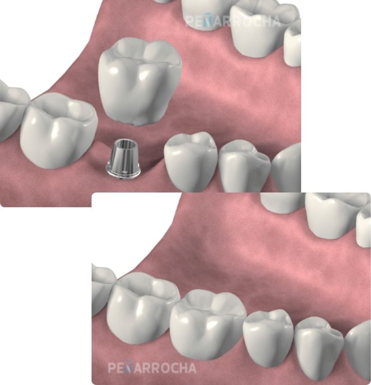 ejemplo protesis sobre implantes cementadas