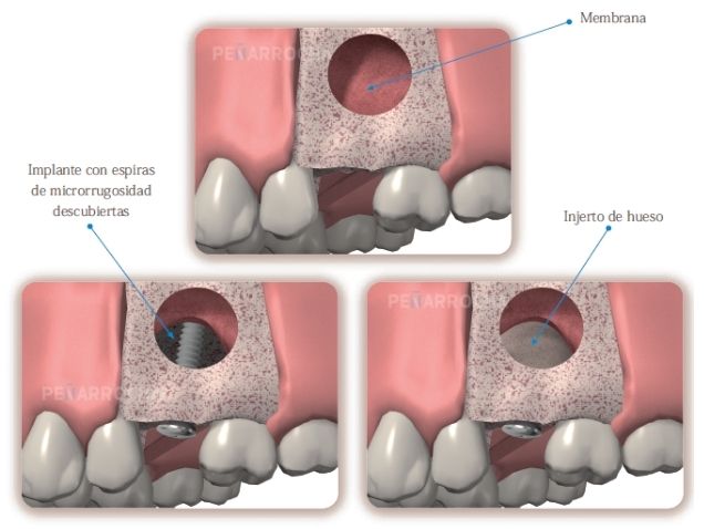 elevacion directa de seno maxilar