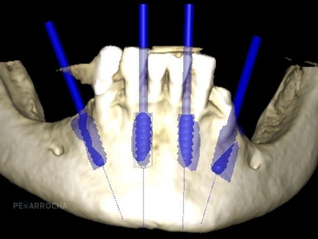 Elevación indirecta de seno maxilar