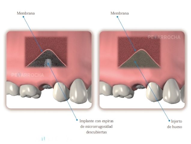 elevacion indirecta de seno maxilar