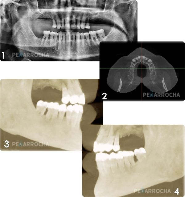 funcionamiento tratamiento pasos 1 2 de los implantes de carga inmediata en valencia
