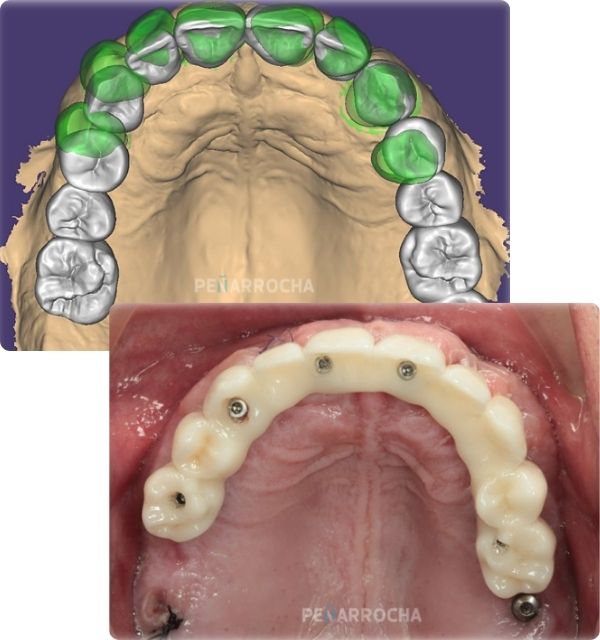 funcionamiento tratamiento pasos 3 4 implantes de carga inmediata en valencia
