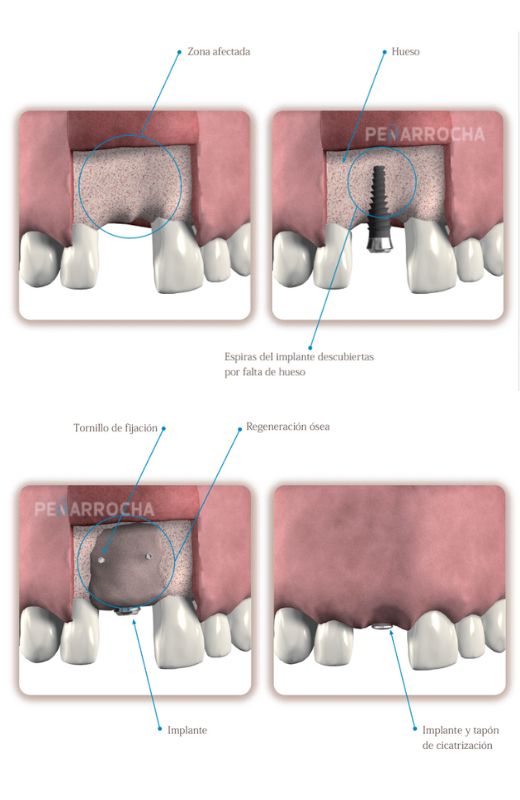 grafico injerto de hueso