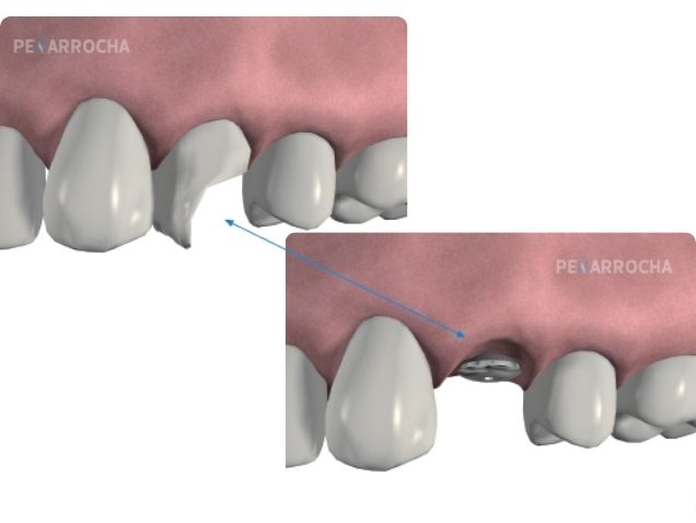 implantes dentales inmediatos en valencia dres penarrocha