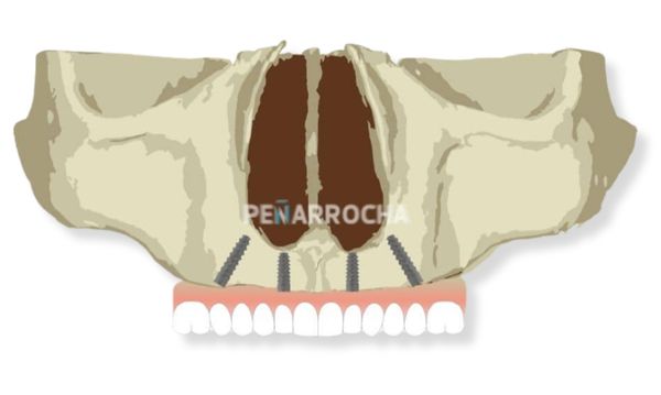 implantes all on four angulados tecnica implantes sin hueso idim clinica de implantes dentales en valencia