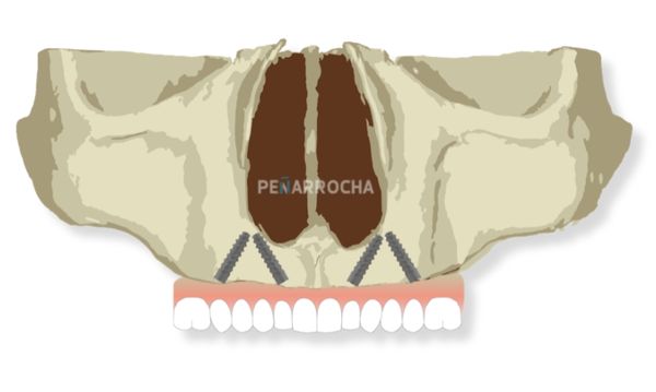 implantes angulados diseno