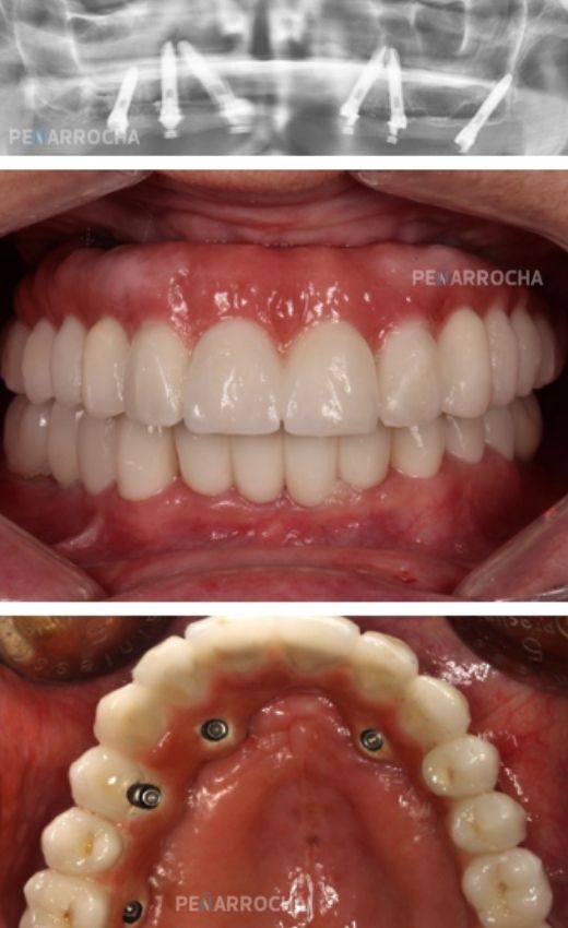 implantes angulados resultados