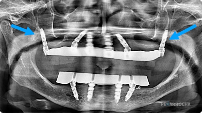 implantes pterigoideos