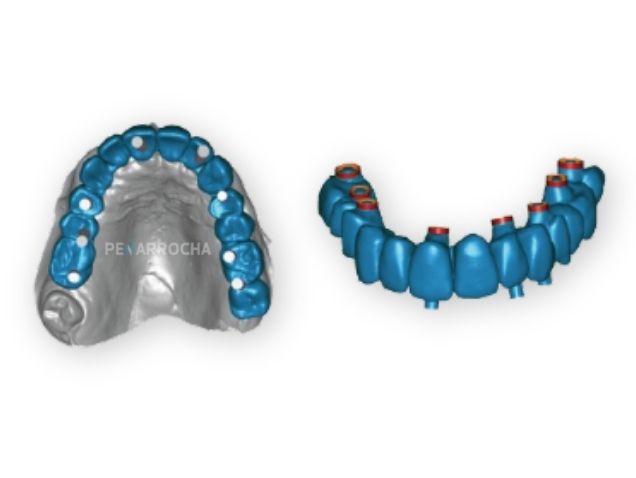 portada implantes de carga inmediata en valencia