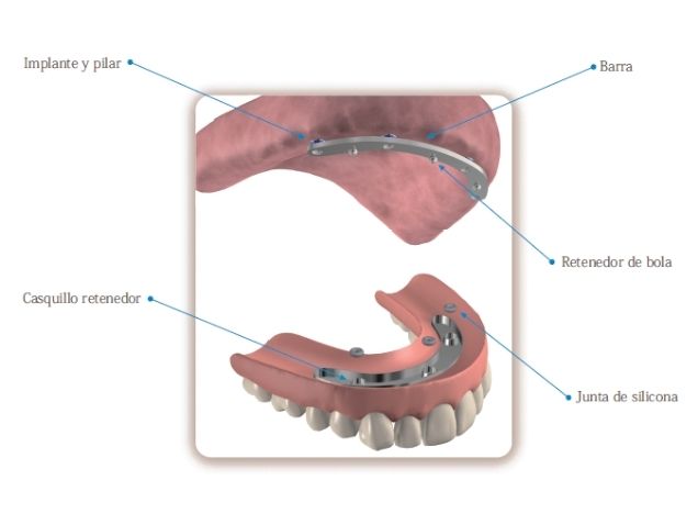 protesis removibles con barra