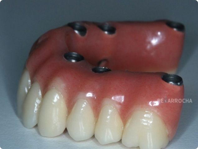 protesis sobre implantes tipos