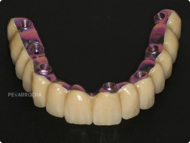 protesis sobre implantes versus protesis convencionales