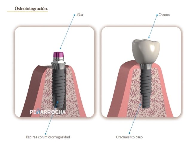 ventajas implantes dentales en valencia dres penarrocha cirugia e implantologia oral en valencia