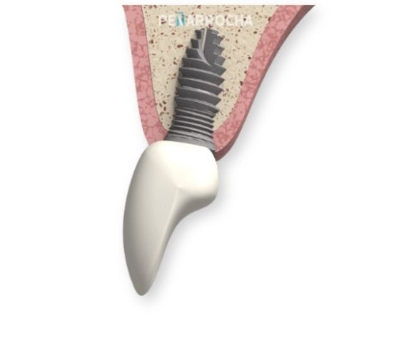 que son los implantes dentales en valencia dres penarrocha cirugia e implantologia oral en valencia