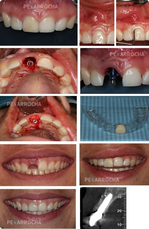 secuencia caso tratamiento implantes inmediatos