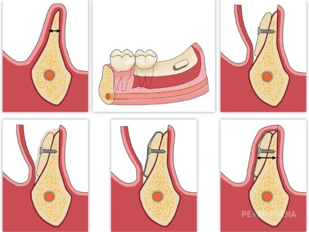 tecnica injerto hueso