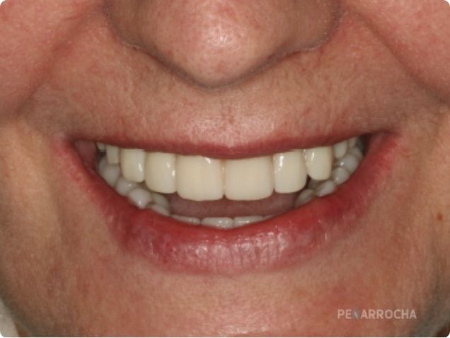 ventajas de las protesis sobre implantes