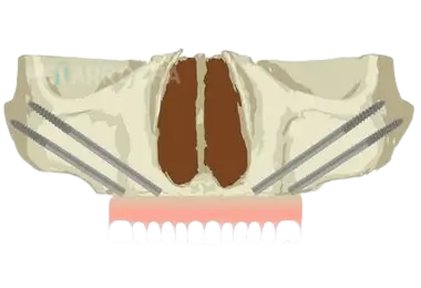 colocacion implantes dentales cigomaticos en valencia dres penarrocha cirugia e implantologia oral en valencia