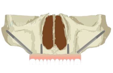 colocacion implantes dentales cigomaticos en valencia hibridos dres penarrocha cirugia e implantologia oral en valencia