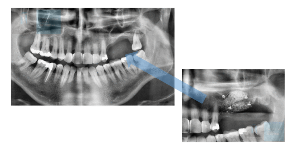indicaciones elevacion de seno maxilar en valencia dres penarrocha cirugia e implantologia oral en valencia