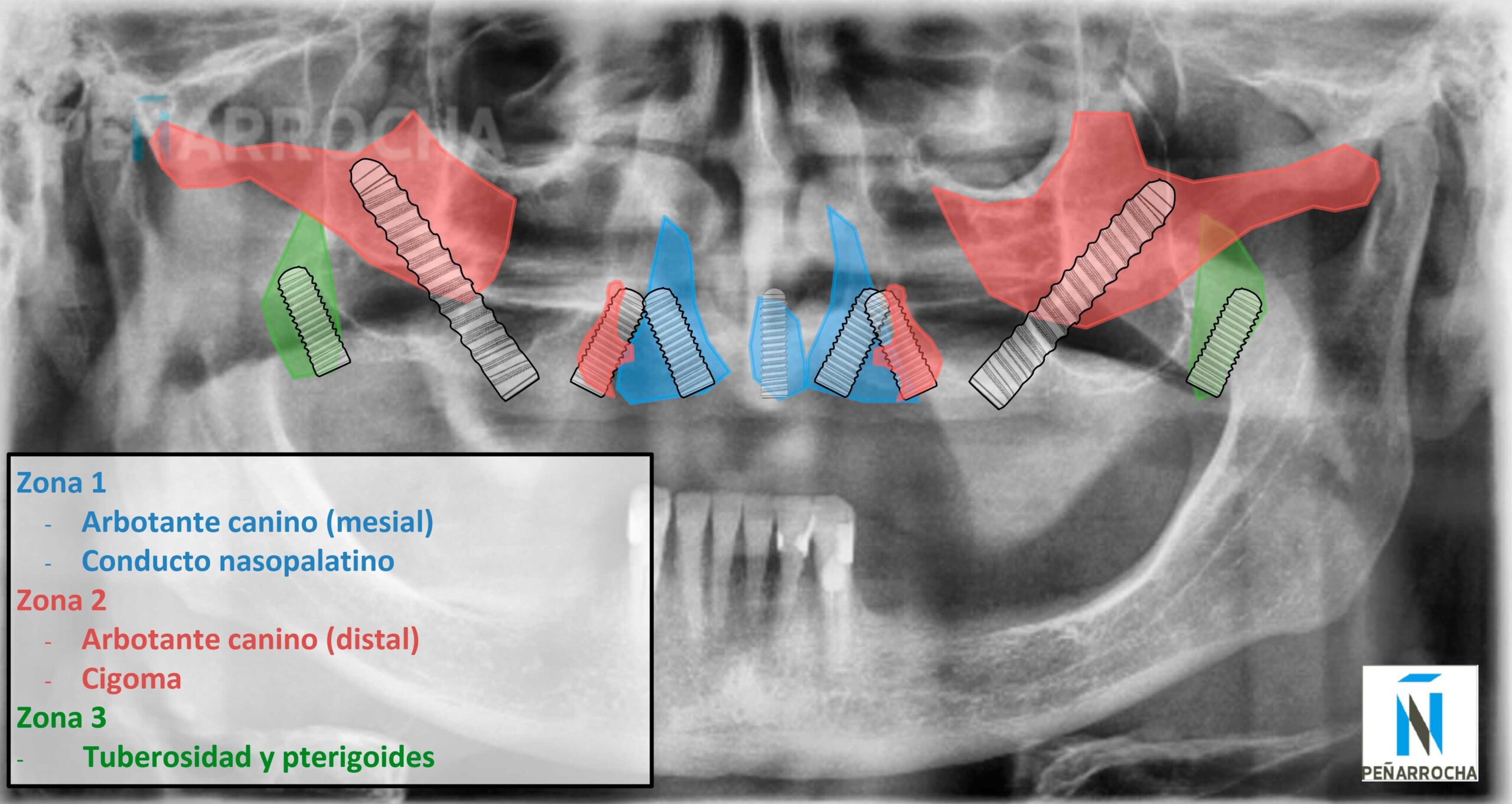 donde se pueden colocar implantes dentales con poco hueso en valencia con los dres penarrocha especialistas en cirugia e implantologia oral en valencia