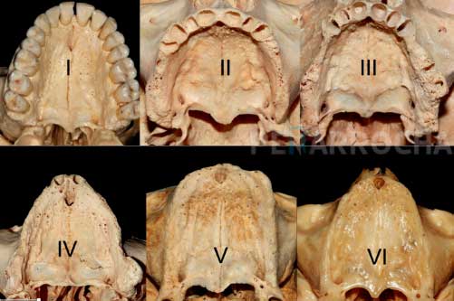 grados atrofia implantes dentales con poco hueso en valencia dres penarrocha cirugia e implantologia oral en valencia