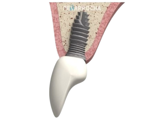 implantes dentales en valencia con los dres penarrocha expertos en cirugia e implantologia oral en valencia